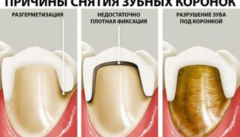 Как часто нужно менять зубные коронки